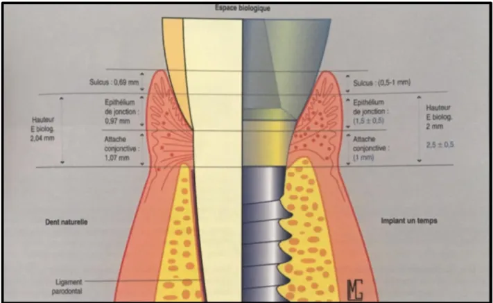 Fig. 1.11. Comparaison du système d’attache d’une dent naturelle et d’un implant. (20) 