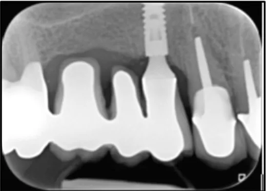 Fig. 2.1. Bridge dento-implanto-porté de 14 à 17, ayant pour pilier naturel 17,                            et pour pilier implantaire 14 (courtoisie Radiographie Dr J
