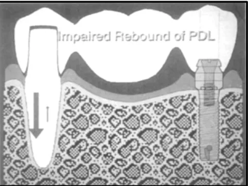 Fig. 2.6. Illustration de l’intrusion du pilier dentaire par altération de la mémoire  élastique de la dent