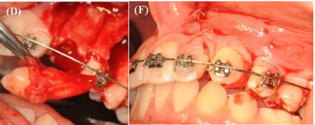 Figure 13 : Autotransplantation d’une canine maxillaire (Gonnissen et al. 2010) 