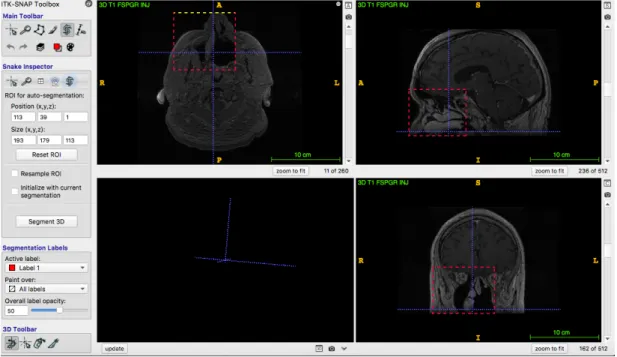 Figure 64 : Capture d’écran ITK-Snap : la zone d'intérêt est sélectionnée. 