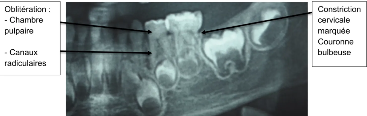 Figure 2 : cliché du secteur 7 d’un patient (CHU de Bordeaux) atteint de dentinogenèse  imparfaite
