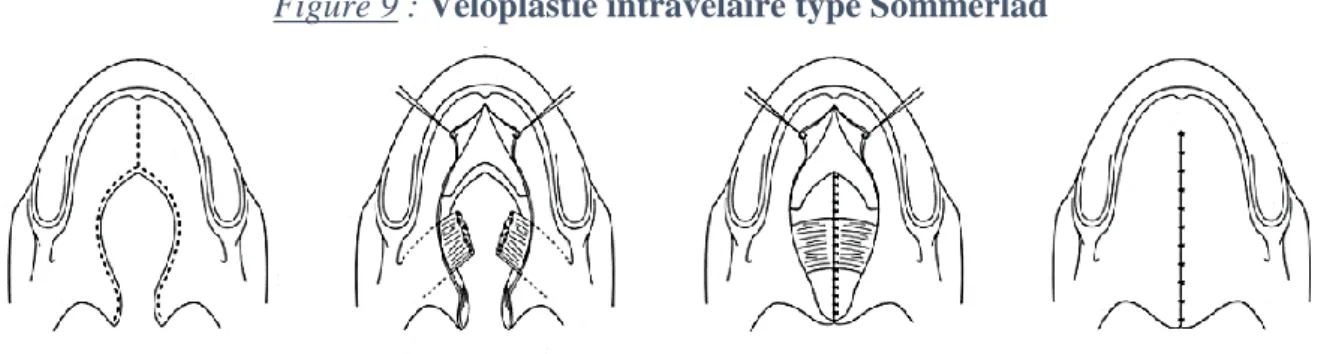 Figure 9 : Véloplastie intravélaire type Sommerlad  