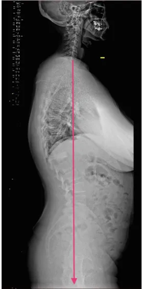 Figure 3 : Radiographie du rachis entier en charge de profil d’une fracture de D12 ancienne traitée par  kyphoplastie