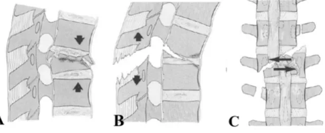 Figure 4: Types de fractures selon Magerl (A : compression ; B : distraction ; C : rotation) 