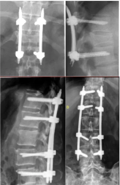 Figure 7: Radiographies de rachis dorso lombaire face et profil avec le système d'ostéosynthèse  SEXTANT (en haut) et LONGITUDE (en bas) 
