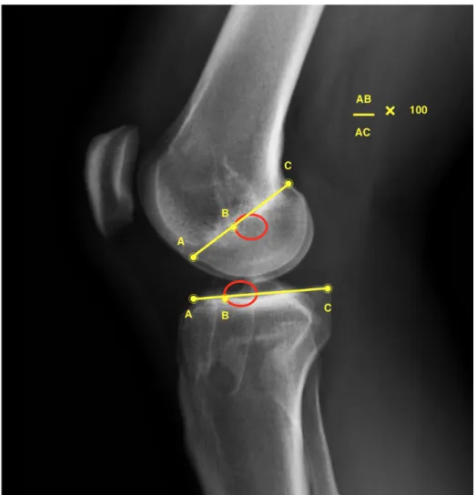 Figure 4: Analyse radiographique du positionnement du tunnel tibial et fémoral selon la  méthode d’Aglietti sur un cliché de profil du genou