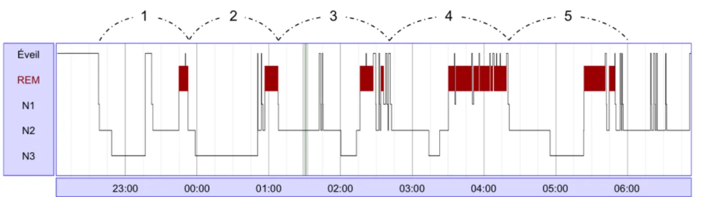 Figure 2 : hypnogramme mettant en évidence 5 cycles de sommeil. 