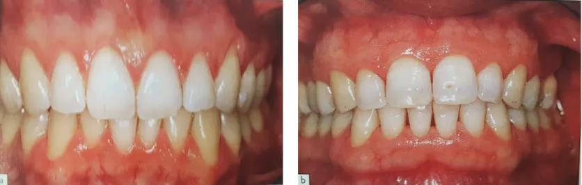 Figure 2 : a) Exemple de parodonte fin et festonné (2)  Figure 2 b) Exemple de parodonte plat et épais 