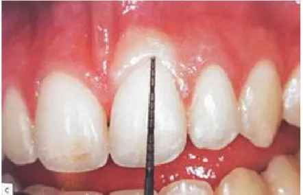 Figure 6 : Mesure de la profondeur de sulcus pour déterminer la hauteur de gencive attachée (2)