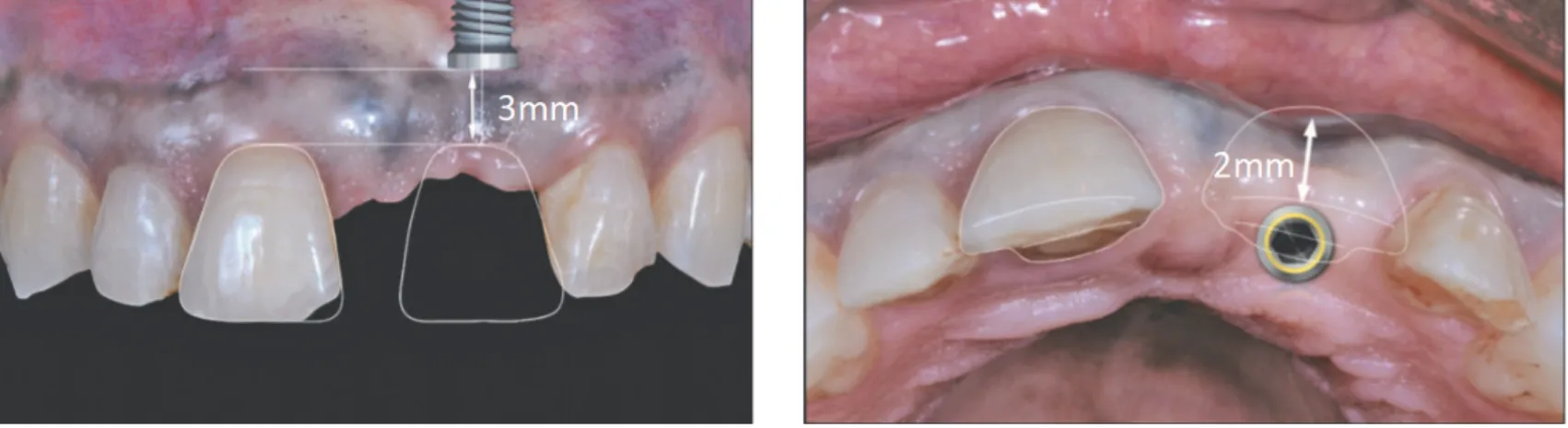Figure 7 a) Positionnement de l’implant à 3mm au dessus du rebord gingival    b) Postionnement de l’implant au centre de l’édentement (12) 