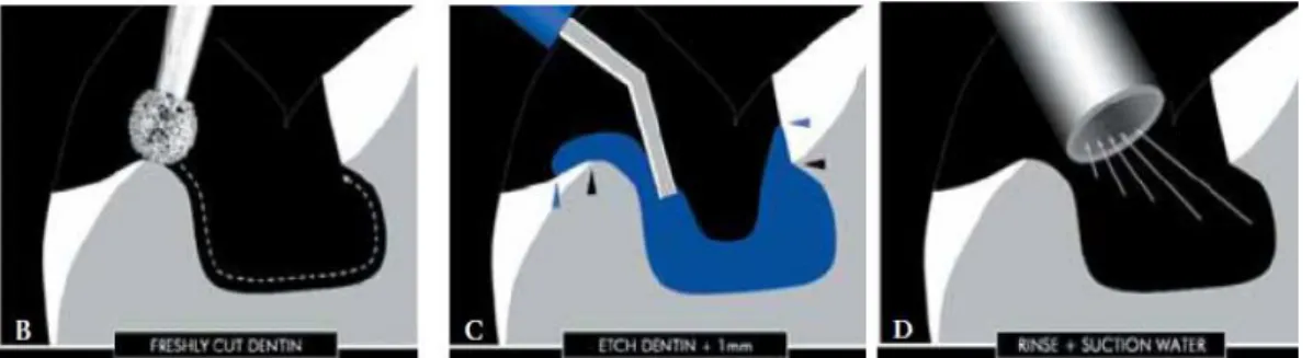 Figure 7: Mordançage, rinçage et séchage de la dentine (48) 