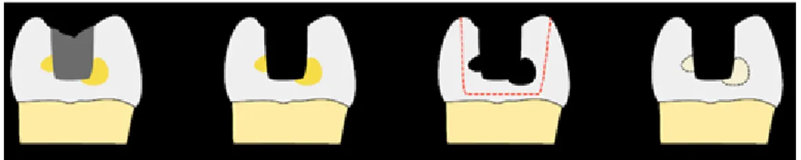 Figure 9: Suppression des contre-dépouilles (2) 