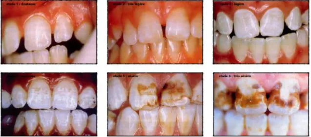 Figure 3 : Droz D et Fraysse C. Degrés de fluorose dentaire (Inf. Dent 1997 ;47 : 1887-1891) 