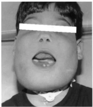 Figure 12 : Photographie post-opératoire d’une trachéotomie réalisée chez un patient atteint  de chérubisme (32) 
