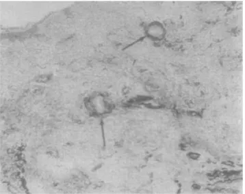 Figure 16 : Coupe histologique d’un manchon péri-vasculaire de collagène éosinophile  spécifique des lésions du chérubisme (flèches) (43) 