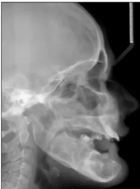 Figure 18 : Téléradiographie de profil d’une jeune femme de 19 ans et 3 mois atteinte de  chérubisme (45) 