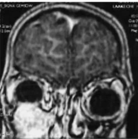 Figure 21 : IRM en séquence pondérée T1 après injection intra-veineuse de Gadolinium dans  le plan coronal (48) 