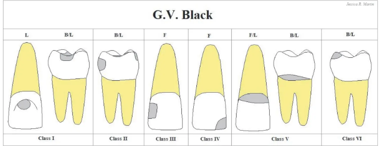 Figure 3 : Schéma de la classification de BLACK (5)  -  Classe I : Caries des puits et sillons des dents postérieures 