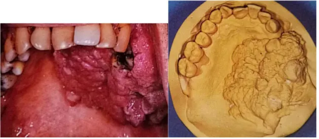 Figure 12 A : Empreinte primaire d’une tumeur palatine d’après J. Beumer (34). 