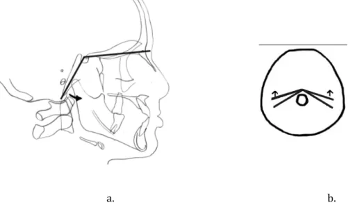 Figure 3: schéma de la fermeture de l’angle sphénoïdal dans les classes III : a. vue sagittale ; b