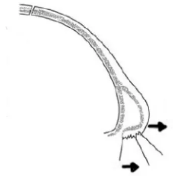 Figure 4 : Dislocation des deux corticales du frontal  (d’après Vesse (1)).