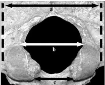 Figure 15 : mesures bicondylaires. (a) BCB, (b) MxID, (c) MnD (17) 