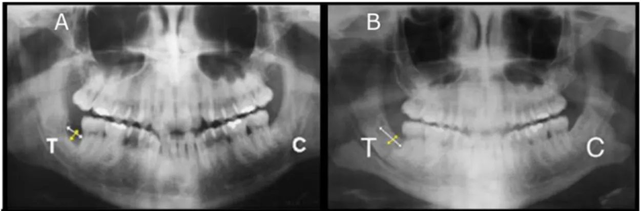 Figure 5 : Régénération d'un défaut osseux mandibulaire par implantation d'un produit d'ingénierie  tissulaire composé de DPSCs et de collagène, d'après d'Aquino et al