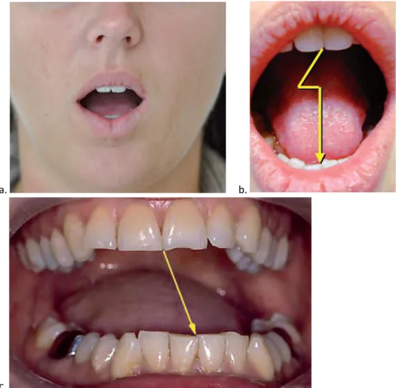 Figure 2 : Distinguer les anomalies de la cinématique mandibulaire : a : limitation d’ouverture  buccale (&lt; 30 mm) ; b : ouverture avec déviation ; c : ouverture avec déflexion.(4) 