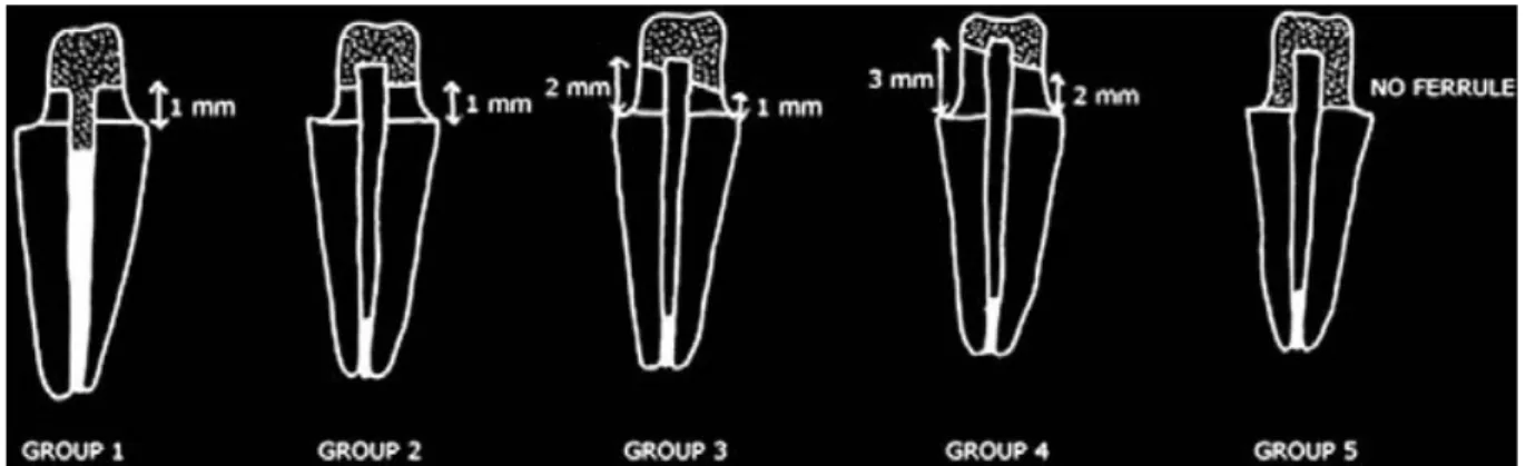 Figure 8 Différentes configurations de cerclage pour une dent monoradiculée d'après Sherfundhin et coll.(17) 