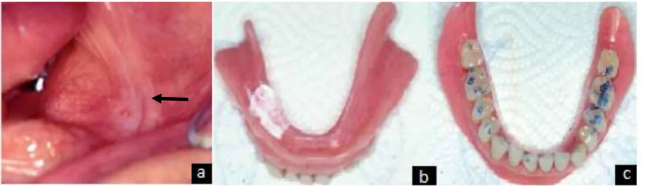 Figure 5 : Blessure suite au port d’une prothèse totale mandibulaire  11 a : Blessure en zone retro-molaire 