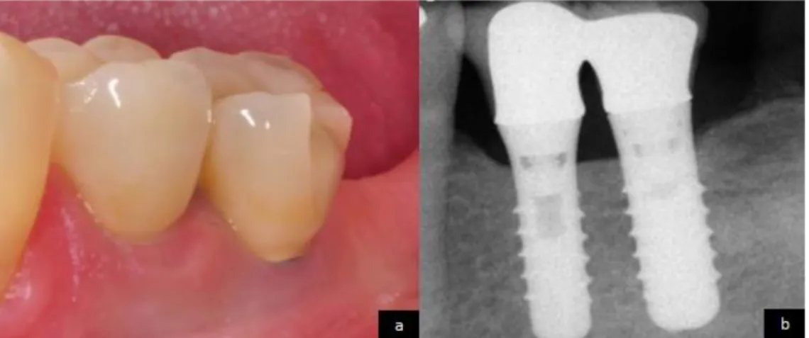 Figure 31 : Fracture de cosmétique sur une coiffe implanto-portée  101 a : Vue intra buccale  