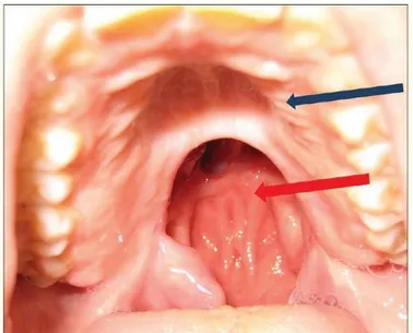 Figure 10 :  Palais dur intact (flèche bleue), et palais mou réséqué engendrant  une insuffisance palatine (flèche rouge) (17) 