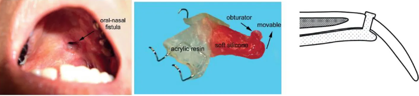 Figure 18 : a. fistule oro-nasale ; b. prothèse avec obturateur souple ; c. relation  entre le palais et l’obturateur 