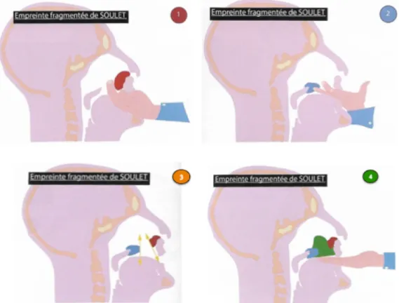 Figure  6 :  Protocole  de  l’empreinte  fragmentée  selon  Soulet :  1.  Empreinte  de  la  contre- contre-dépouille  antérieure  avec  un  silicone  par  addition  de  haute  viscosité