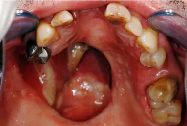 Figure 16 : Photographie intrabuccale de l’arcade maxillaire montrant l’étendue de la PDSM  chez Monsieur B