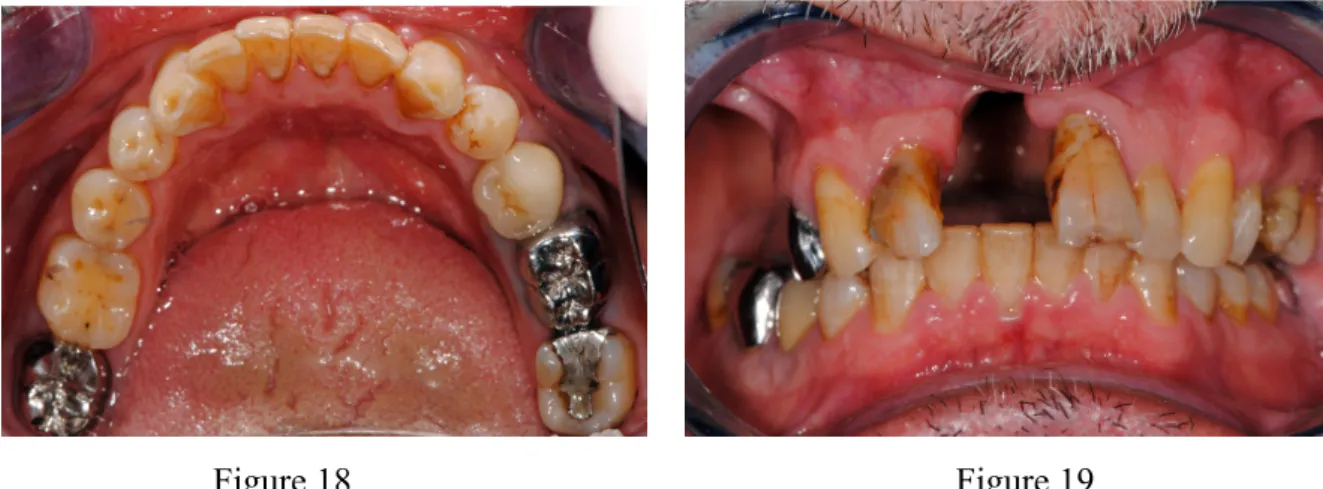 Figure 18 : Photographie intrabuccale de l’arcade mandibulaire de Monsieur B.  