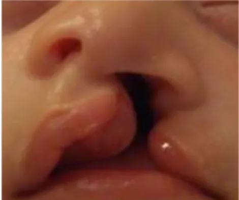 Figure 1 : Fente labio-palatine chez un nourrisson   (crédit : Dc Bigorre) 