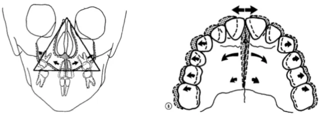 Figure 1 : Disjonction palatine maxillaire sous forme de V horizontal et frontal (5) 