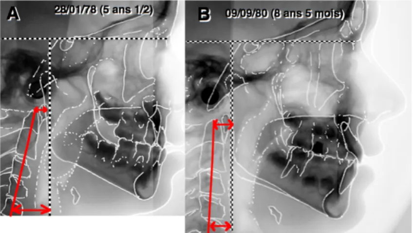 Figure 7 : (A) 5 ans 1/2, ventilation buccale rachis oblique. (B) 8 ans 1/2 après ablation des amygdales et normalisation de 