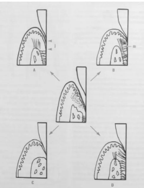 Figure 2 Types de cicatrisation parodontale(A) Long épithélium de jonction (i) (B) Manchon fibreux  supracrestal (m) (C) Ankylose(D) Régénération