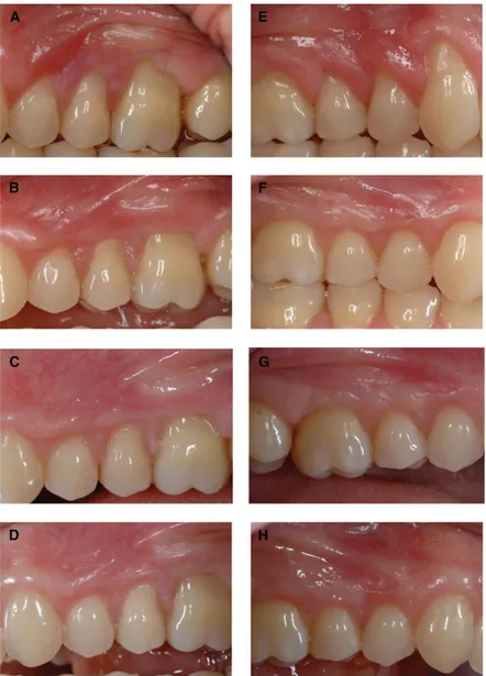 Figure 13 Résultats du traitement de défauts type récessions multiples et adjacentes sur le même patient: Site  test A ( avant chirurgie)B ( à 1 mois)C (à 3 mois)D ( à 6 mois); Site contrôle E ( avant chirurgie)F (à 1mois)G (à 