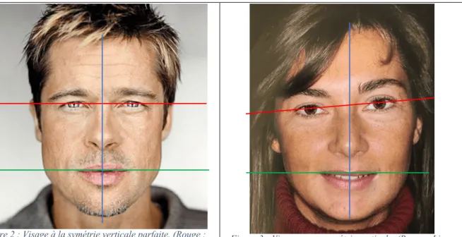 Figure 2 : Visage à la symétrie verticale parfaite. (Rouge :  Ligne pupillaire, Bleu Ligne médiane, Vert Ligne  bi-comissurale)