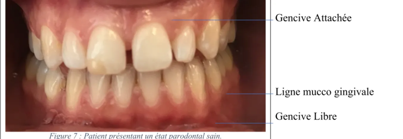 Figure 7 : Patient présentant un état parodontal sain. 