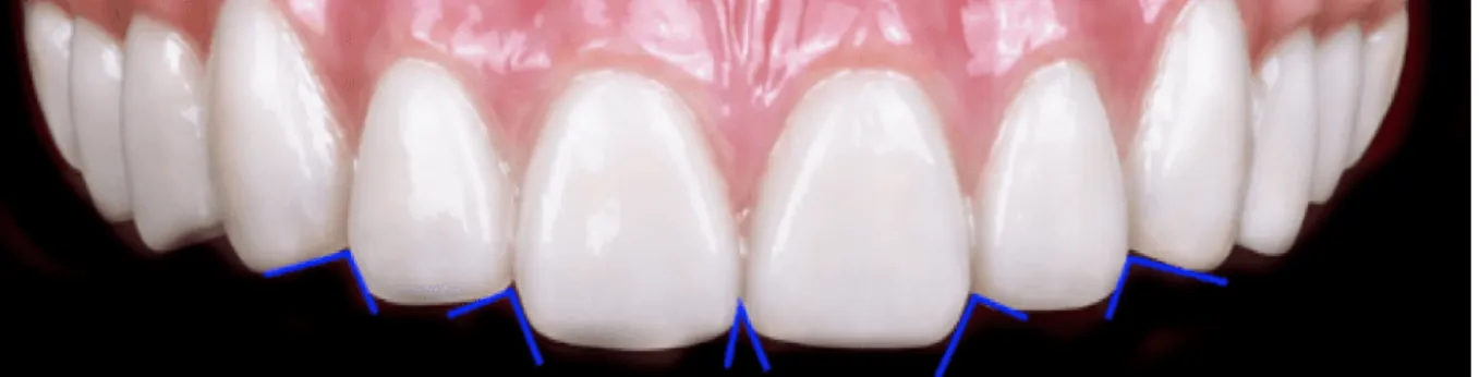 Figure 23 : Angles inter-incisifs (tracés bleu) des six dents antérieurs maxillaires 