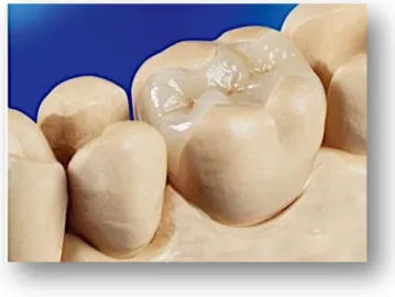 Figure 5 – Inlay dentaire en céramique. 