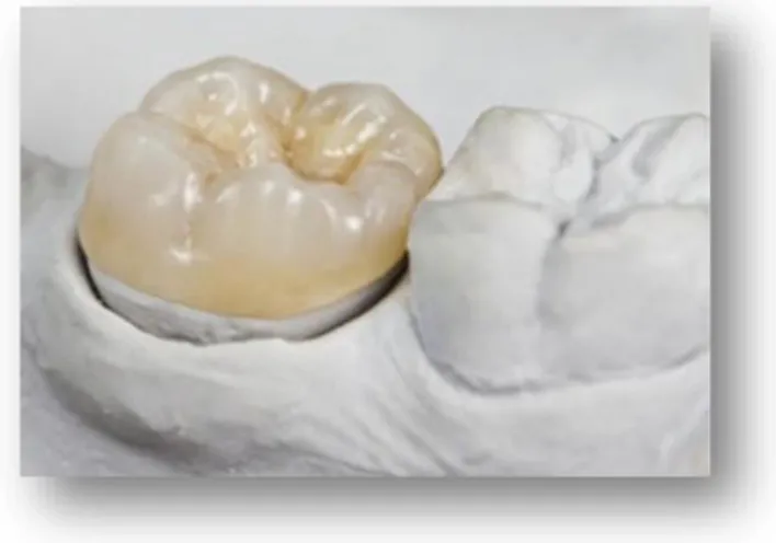 Figure 7 – Overlay dentaire en céramique. 