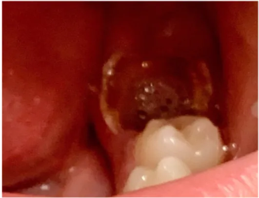 Figure 6 : Cliché photographique d’une première molaire permanente mandibulaire gauche à l’état  de débris radiculaire 