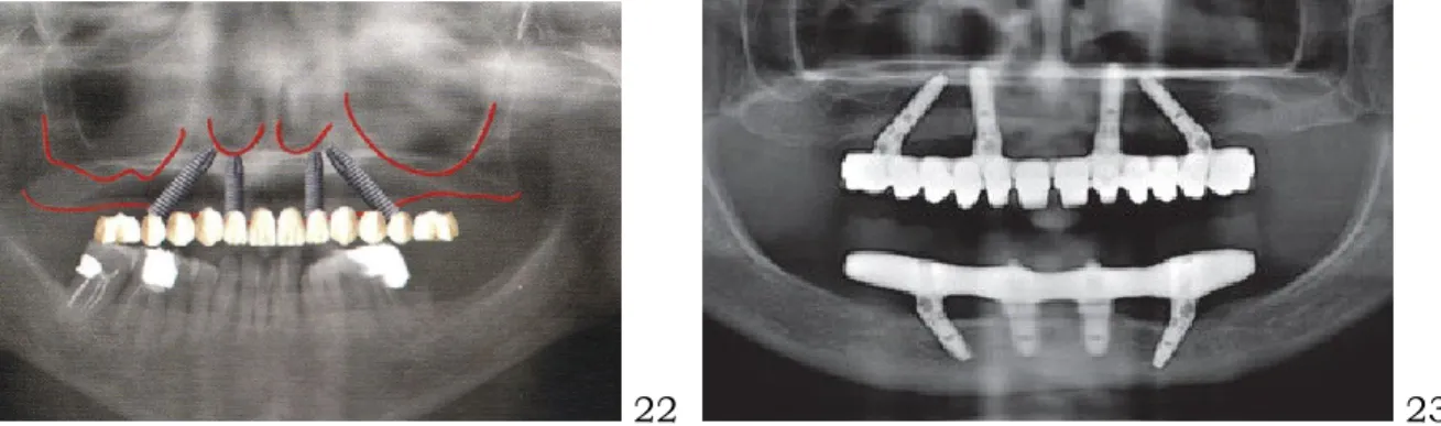 Fig. 24: Schema d’un “All-on-4” hybride; ( 2)  Fig.25: Vue radiographique d’un “All-on- “All-on-4” hybride.(2) 