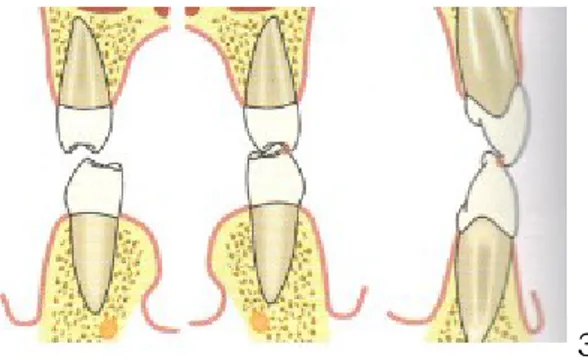 Fig. 31 : Occlusion bilatéralement équilibrée : contacts simultanés bilatéraux en  propulsion et diduction